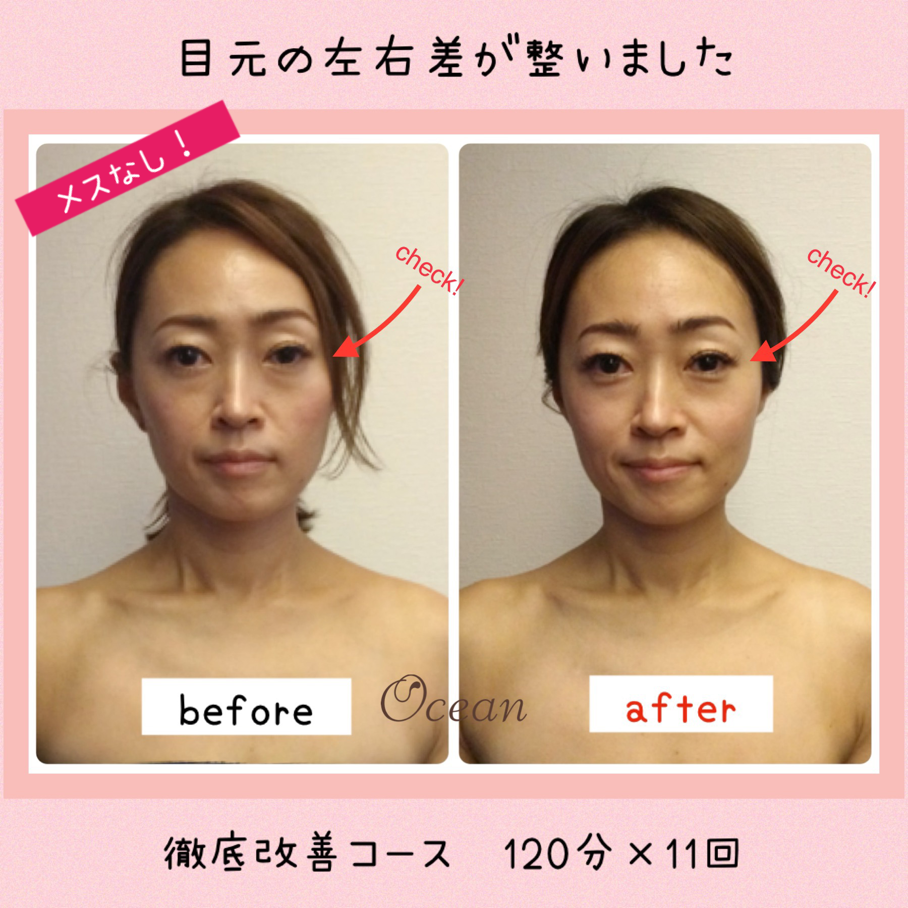 ビフォーアフター 片側だけ瞼が下がる 目の左右差が揃った 小顔矯正 骨盤矯正 美容矯正トータルエステサロン オーシャン Ocean